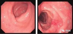 萎缩性胃炎不可怕，只要